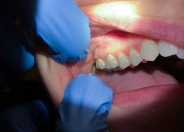 Best Chipped Tooth Repair Near Me  in West Modesto, CA